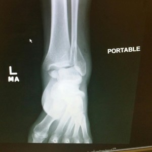 an ankle should not look like that