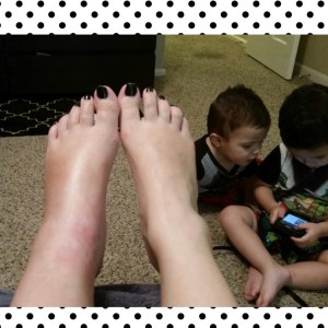 A few hours after my first cast was taken off. Swollen much?